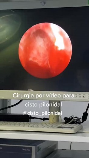 Tratamento Tecnológico para Cisto Pilonidal - Proctologista Passo Fundo