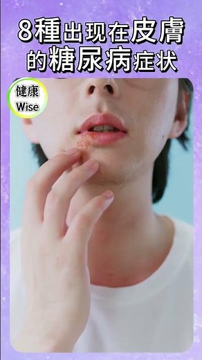 8種出现在皮膚的糖尿病症状，癢不停、總感染？別再怪膚質差，你可能該驗血糖了，前兆？不能忽視的症狀 ，你的身體正提醒你血糖失控 | 健康Wise