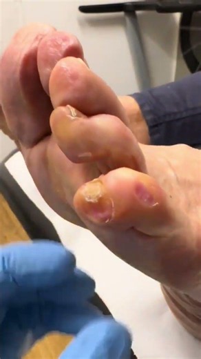 Amazing Little Toe Transformation Corn & Callus Removal by Podiatrist #FootCare #Podiatry
