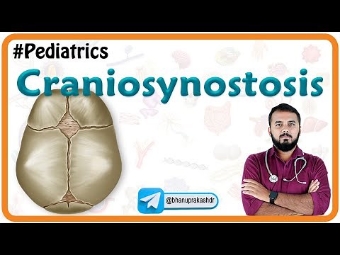 Craniosynostosis : Types, Causes, Diagnosis and Treatment : Pediatrics National exit test