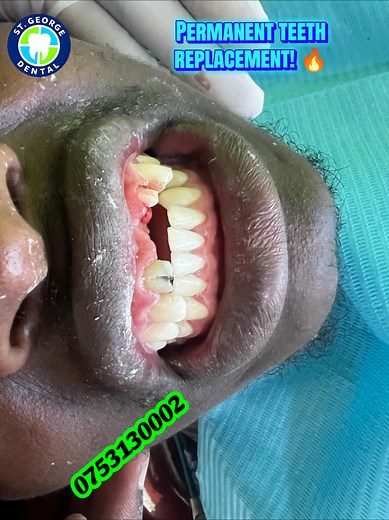 Well-Executed 3-Unit Dental Bridge Explained