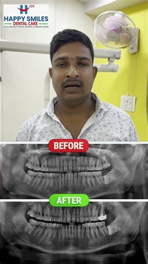 Painless Wisdom Tooth Extraction & Cap Fixing || Happy Smiles