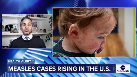 4 times as many measles cases in few weeks than US typically averages in year: CDC