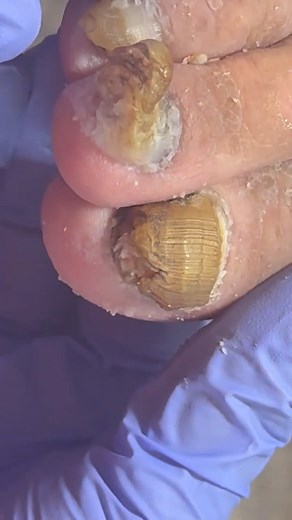 4.2K views · 21 reactions | She Tried to Paint Her Toenails — But One Nail Started Moving M621 #toenails #pedicure #toenailremoval #fblifestyle #fypシ | Perfect Toe Care | Facebook