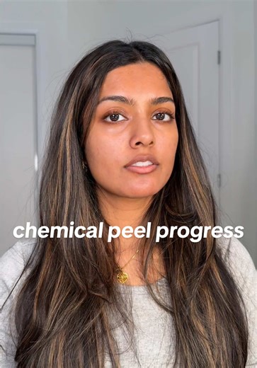 omg the progress has been insane🤌 only 3 more weeks of this treatment to go!! @Dermalogica Canada #skintreatment #chemicalpeel #chemicalpeeling