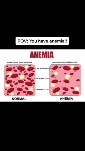 Identifying Anemia Symptoms: How Many Do You Have?
