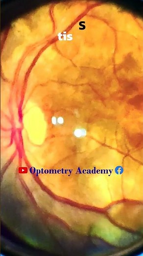 Serpiginous Choroiditis | choroiditis | Fundus Videography | Fundus Photography | Short Video 252