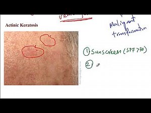 USMLE ACE Video 193: Skin Cancers: Key Characteristics, Risk Factors, and Treatments