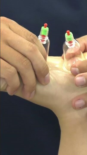 Dynamic cupping for plantar fasciitis