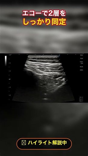 【実践】仙腸関節性腰痛、8割は「関節の外」って知ってましたか？