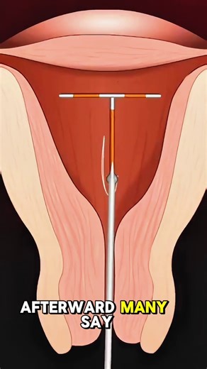 12K views · 41 reactions | IUD #IUD #IntrauterineDevice #BirthControl #Contraception #LongTermContraception #ReproductiveHealth #WomensHealth #FamilyPlanning #CopperIUD #HormonalIUD #IUDInsertion #IUDRemoval #Gynecology #PreventPregnancy #IUDBenefits #IUDSideEffects | Surgery Page | Facebook