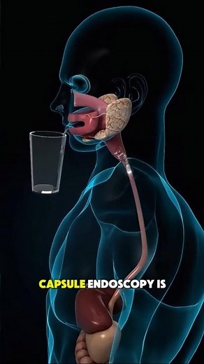 What Happens Inside Your Body During Capsule Endoscopy? 😳📸