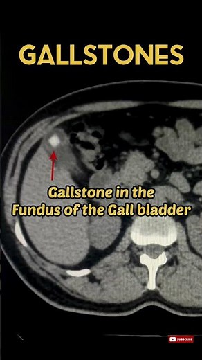 Gallstones Diagnosis Gallbladder CT Abdomen #radiology #gallstones #gallbladder #shorts #ctscan