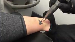 34K views · 472 reactions | Recent advancements in technology have made laser tattoo removal more effective, quicker and less painful! Send a picture of your tattoo in a private message to receive a free price quote. You can also set up a free in person consultation by calling 724-972-7734 or visiting www.disappearinginkltr.com | Disappearing Ink, Laser Tattoo Removal | Facebook