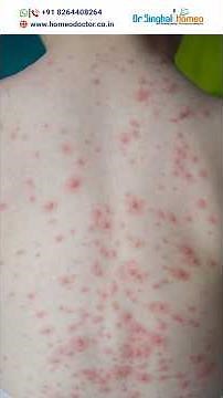 Homeopathic Treatment for Molluscum Contagiosum | Dr. Vikas Singhal #molluscumcontagiosum