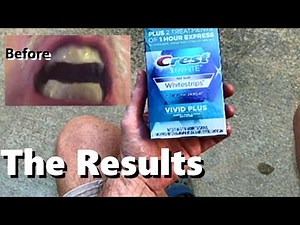 CREST Whitening Strips 3D *Before/After 12 Treatments -Vivid Plus Teeth Enamel Cleaning 30 minutes