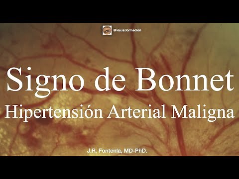 Bonnet's sign. Fundus examination in malignant arterial hypertension.