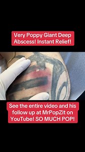 Helping people is what I do, and these procedures are instant relief! See the whole procedure and his follow up at MrPopZit on YouTube! #mpzdermatology #mrpopzit #dermatology #abscess #popaholic