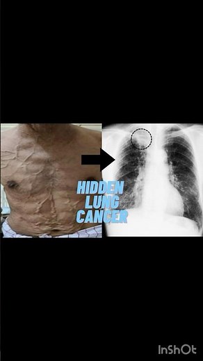 These Dilated Abdominal Veins Revealed Lung Cancer! | SVC Syndrome