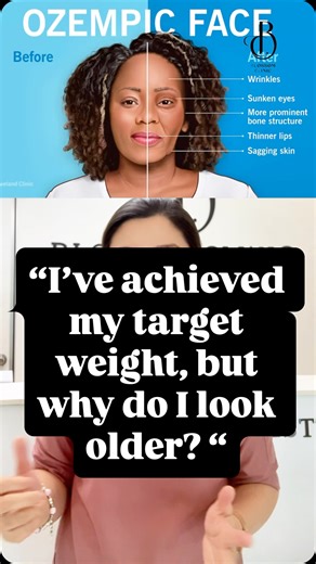Lost the weight ✅ But why do I look older? ❌ Ozempic Face is real — and it’s not just about fat loss. In this video, Dr Fasha breaks down the science behind facial ageing after rapid weight loss and what actually helps. #ozempicface #weightloss #rapidweightlost #blossomclinickl #mounjaro | Blossom Clinic KL