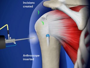The Facts About Shoulder Arthroscopy