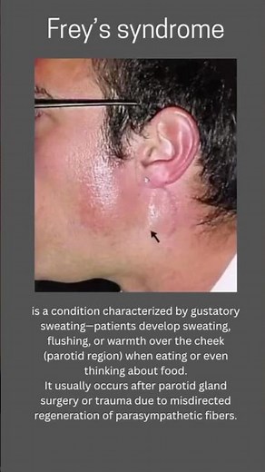 Sweat When You Eat?! 😳 #medical #medicine