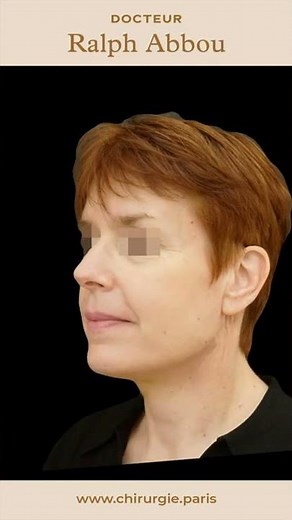 Avant/après lifting du cou par fils tenseurs permanents