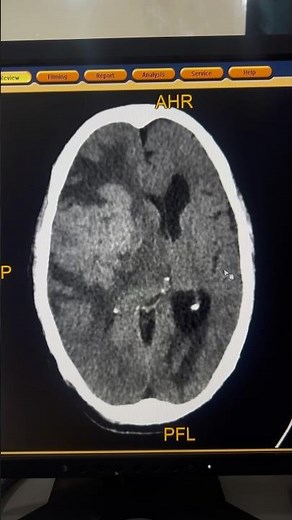 Brain Mass CT Brain | Severe Edema and Midline Shift #shorts