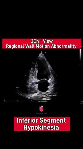 inferior Segment Hypokinesia (2CH View) #echocardiography #2decho #cad #lvfunction