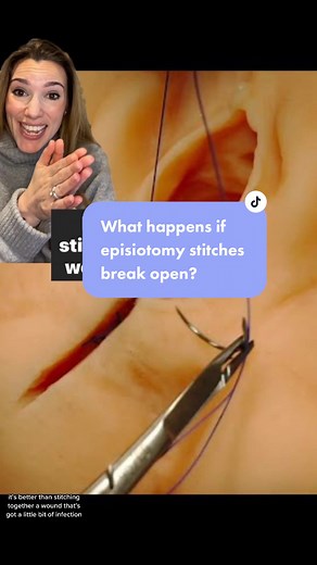 Episiotomy wounds after birth can open, but its not as bad as you might think! #birth #childbirth #pregnancy #thirdtrimester #stitches #surgery #infection