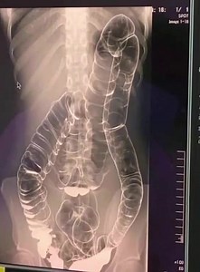 445K views · 125 reactions | This is an X-ray image of a young woman who suffered from chronic constipation. One day, after experiencing continuous symptoms for over two weeks, she went for a medical check-up and received the X-ray results See Details | Knorr | Facebook