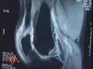 HHH's surgery