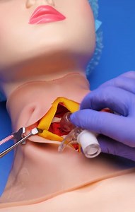 1.4M views · 5.8K reactions | Medical Training Video: Emergency Tracheostomy Procedure | Health is Wealth | Facebook