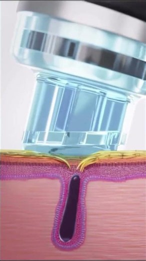 HydraFacial at Enfield Royal Viera | Reveal Smooth, Glowing Skin