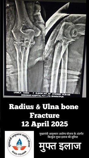 Radius and ulna bone proximal fracture #fracturerecovery #bonefracturetreatment