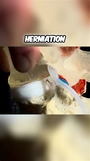 The bigger the disc bulge the easier the fix? #discbulge #discbulgetreatment #lowerbackpain