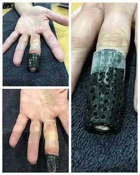 Mallet Finger Splint