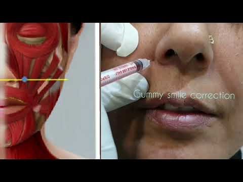 Gummy Smile Correction with Botulinum Toxin
