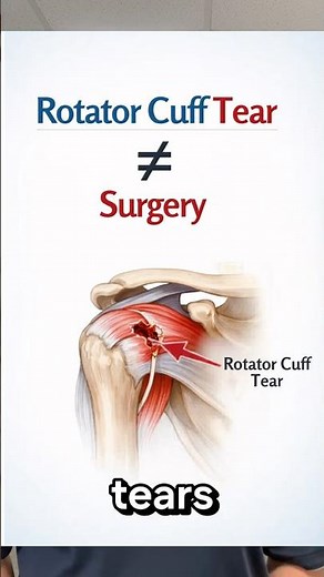 Your Rotator Cuff Tear Probably Doesn’t Need Surgery