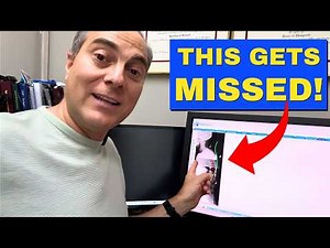 The Missing X-Ray Analysis Behind Sciatica & Lumbar Disc Herniations