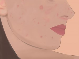 What's up with pandemic pimple breakouts and how to cure them?