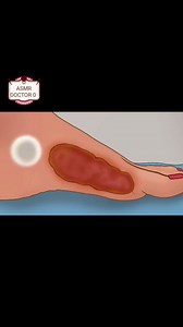 ASMR Treatment For Unmanaged Foot piercing P 3 #asmr #fblifestyles #satisfying | Asmr Aijul