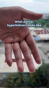 Palms leaving wet handprints everywhere? That’s palmar hyperhidrosis — constant sweating even while sitting still. Not nerves, not weather, just overactive sweat glands. #PalmarHyperhidrosis #SweatyHands #Hyperhidrosis #ExcessiveSweating | Dermadry