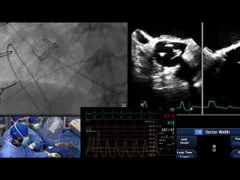 TCT LIVE 2017 BASILICA TAVR demonstration