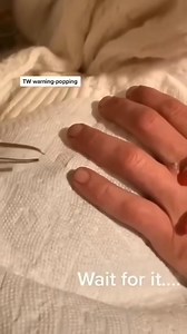 😱 You won't believe what came out of this one... #pimplepop #satisfying | Pimple Popping