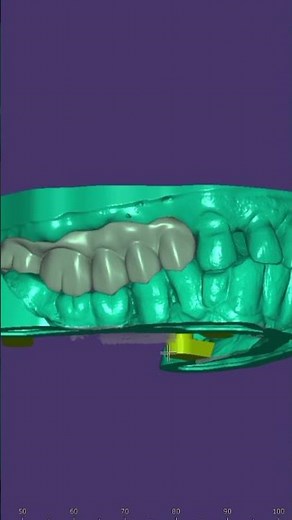 Ultimate Exocad Tutorial: Perfect Upper Bridge Design with Fine Details
