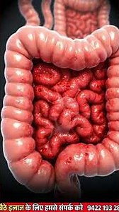 Blood in Stool: Causes and Essential Information