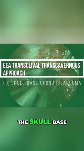 Skull Base Surgery: Conquering the Challenging Cavernous Sinus Region #shorts