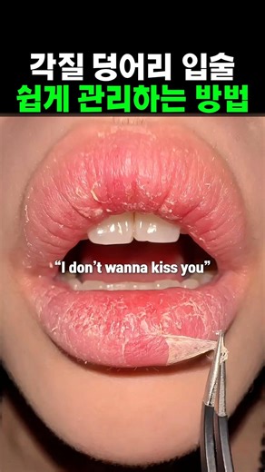 각질 덩어리 입술 가장 쉽게 관리하는 꿀팁