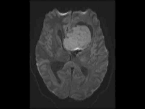 Anaplastic Ependymoma